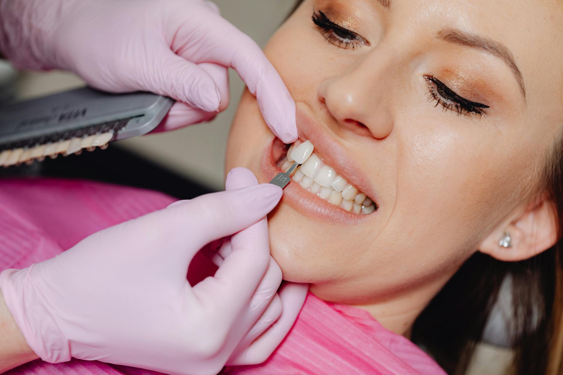 Porcelain veneer treatment